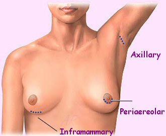 Incision Sites
