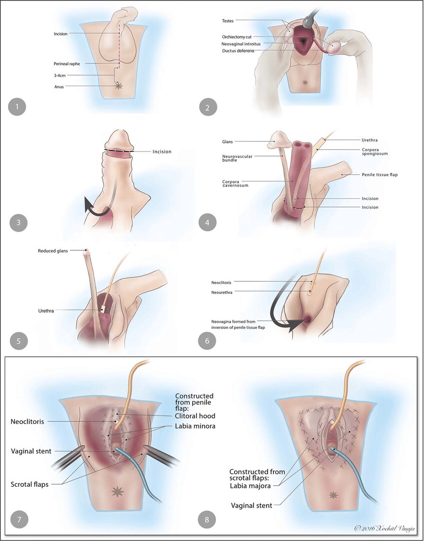 Penile Inversion