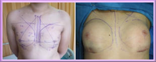 Breast augmentation, Swyer Syndrome